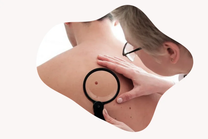 Cinco especialistas en dermatología de Lleida participan en la campaña Euromelanoma 2022 sobre cáncer de piel