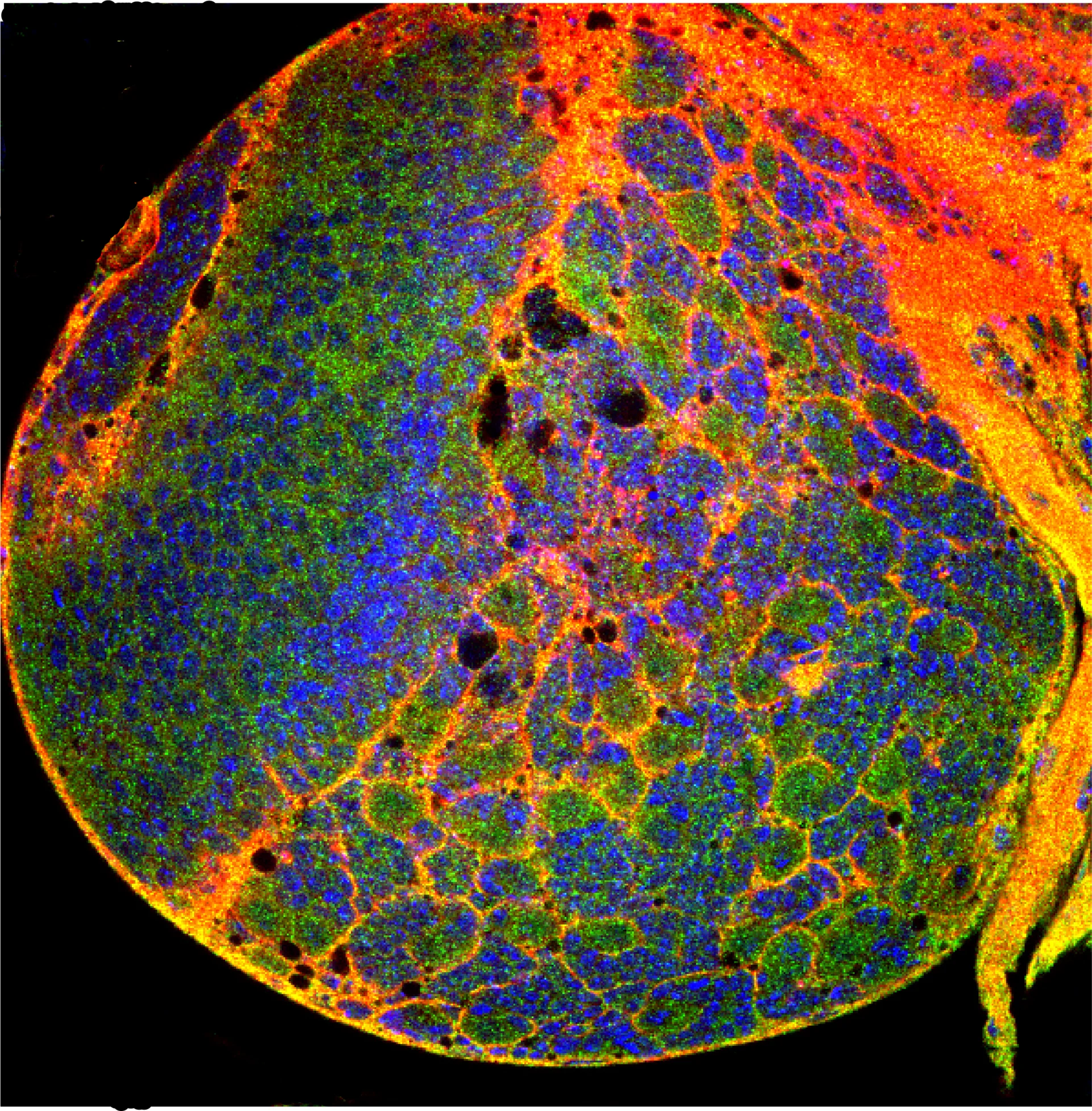 A study using a glioma model in fruit flies identifies a new potential therapeutic target against glioblastoma